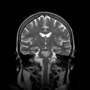 central-pontine-myelinolysis-4 (2) – PinkyBone