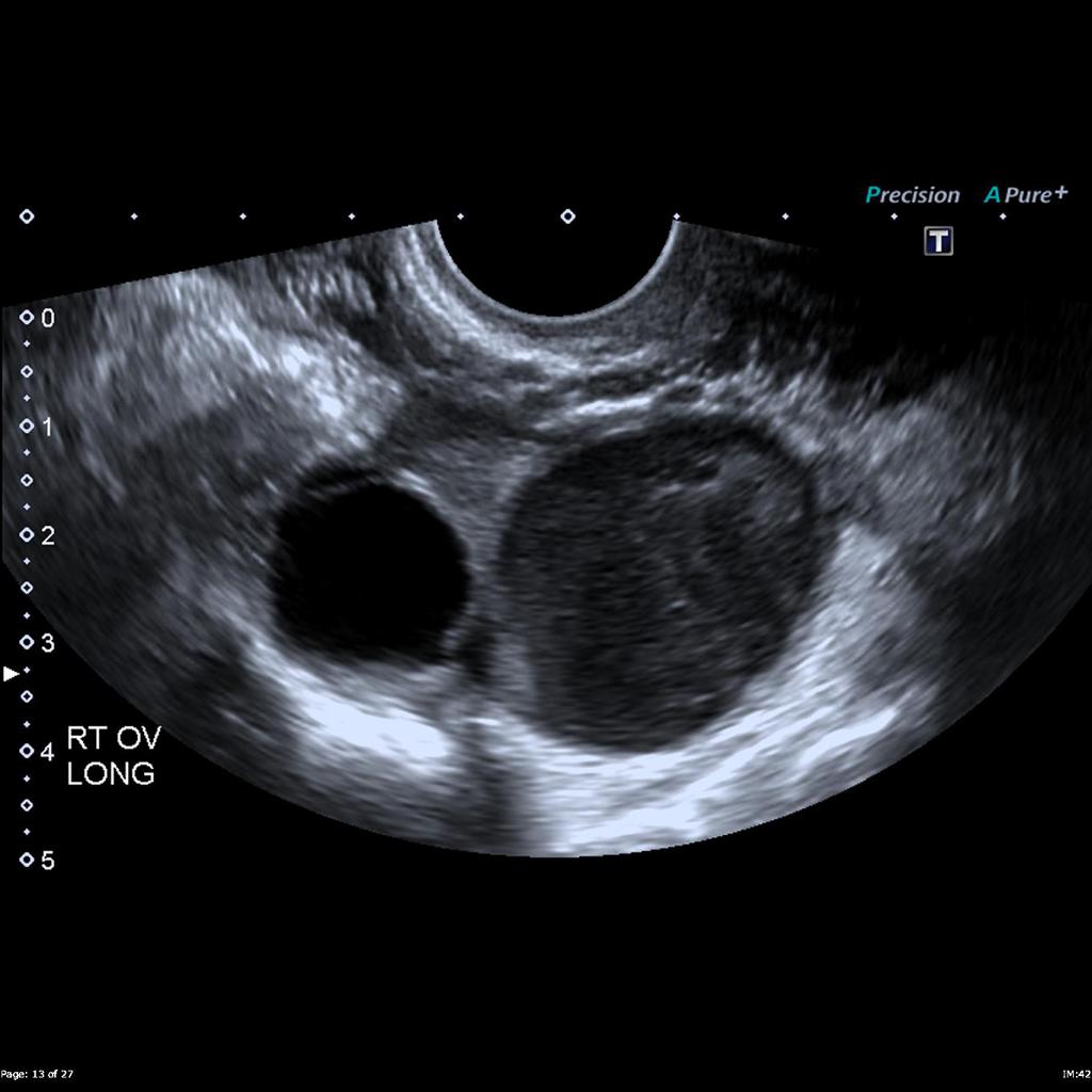 Endometrioma Cyst Ultrasound