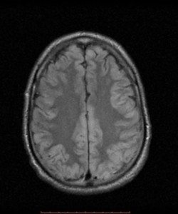 hypoglycemic-brain-injury (11) – PinkyBone