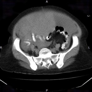 Cancer de l’ovaire avec carcinose péritonéale – PinkyBone