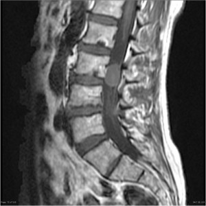 Paragangliome de la queue de cheval – PinkyBone