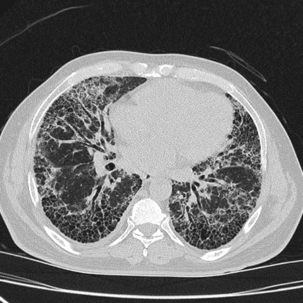 usual-interstitial-pneumonia-uip-2 – PinkyBone