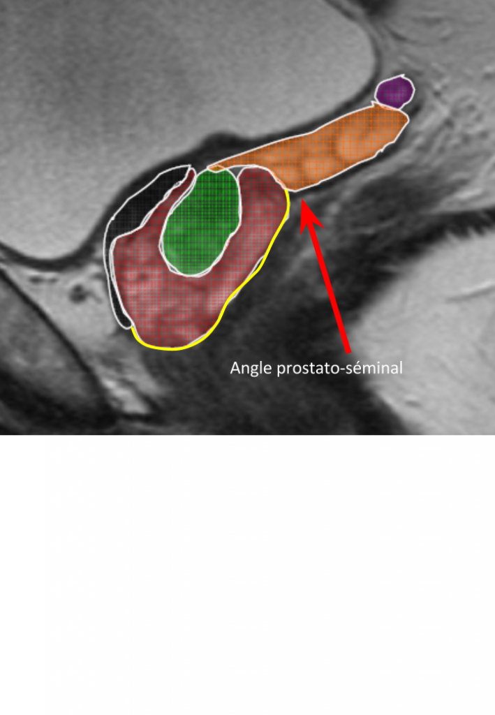 Prostate Irm Pinkybone 4316