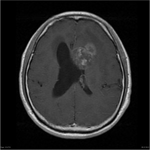 Épendymome du ventricule latéral – PinkyBone