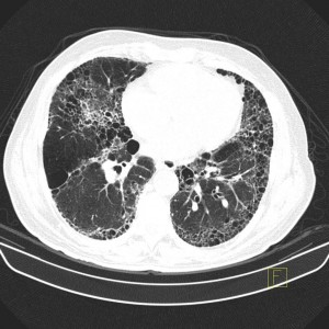 honeycombing-in-an-usual-interstitial-pneumonia-uip-pattern (1) – PinkyBone