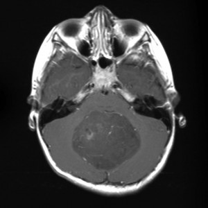 Médulloblastome – PinkyBone