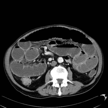 occlusion – PinkyBone