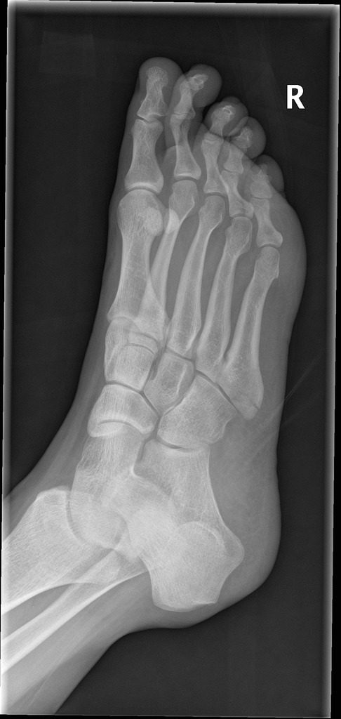 avulsion-fracture-fifth-metatarsal – PinkyBone